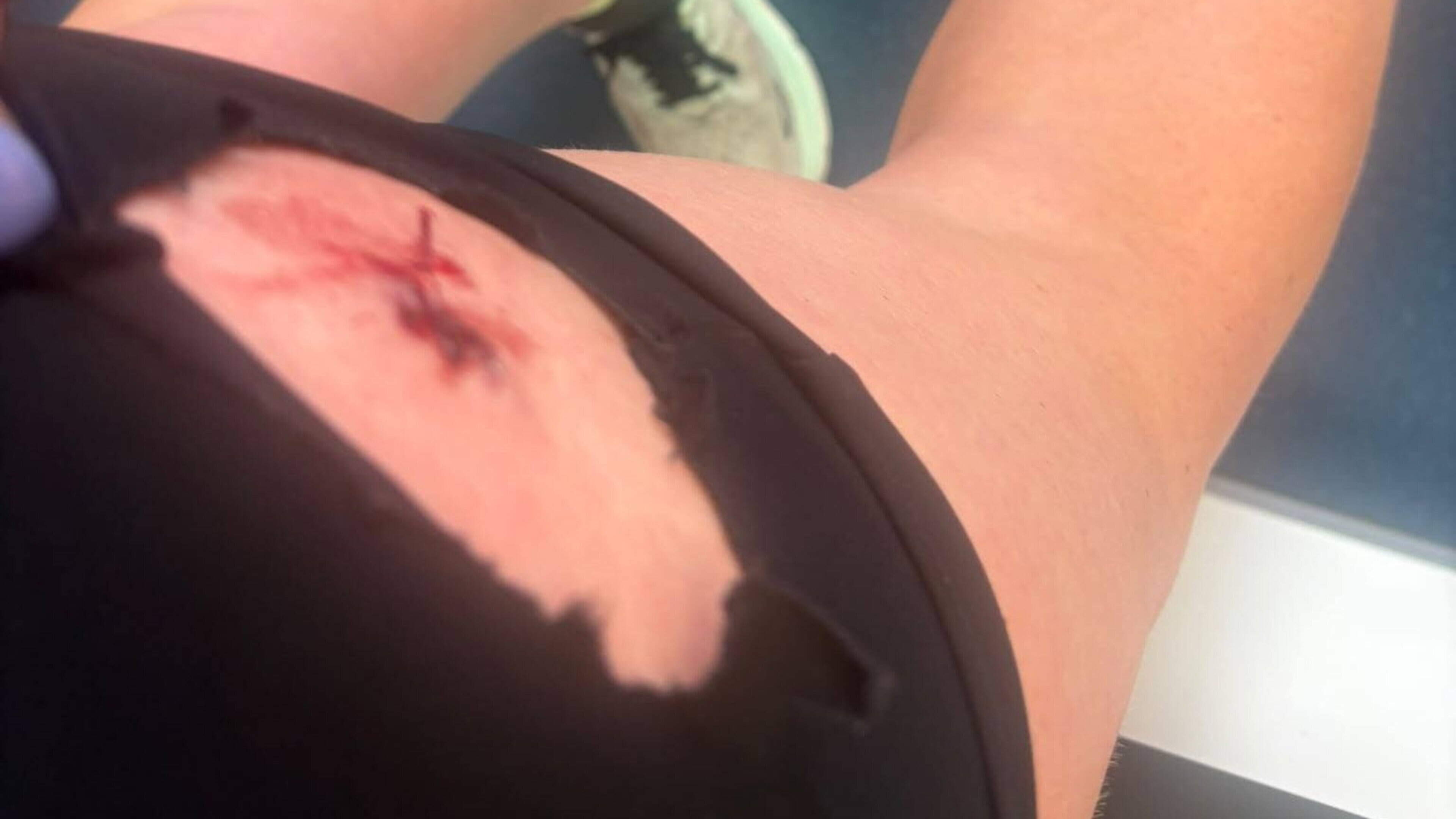 Wexford Woman Attacked by Dog While Running