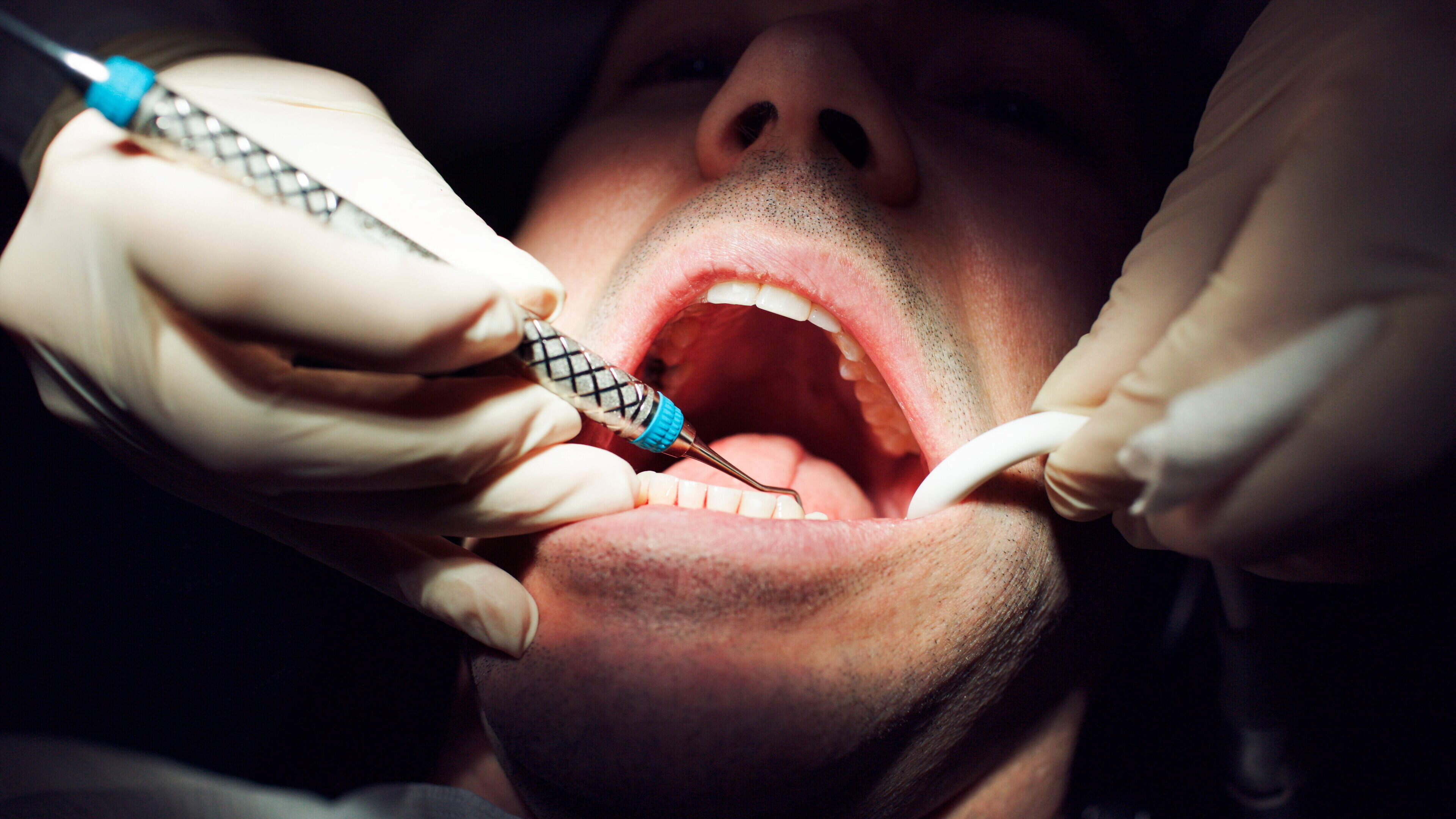 Dental Crisis as Medical Card Dentists Decline