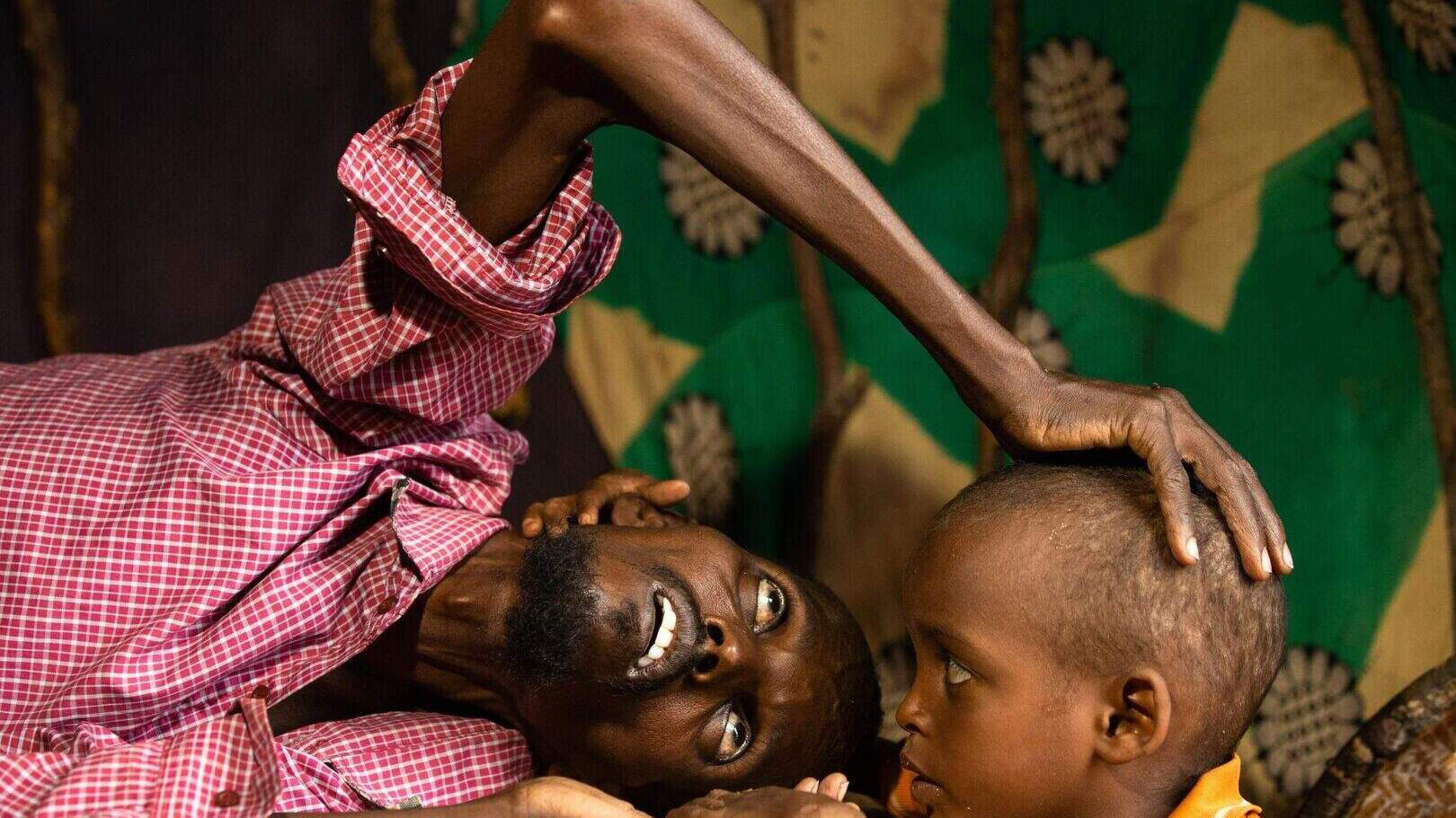 Child hunger surges in Somalia